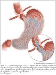 Image result for Pediatric Reflux