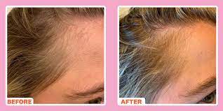 By more firmly rolling the dermaroller over your scalp, creating tiny wounds. Dermarolling For Hair Loss Does It Work Before And After