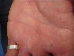 Image result for Diascopy