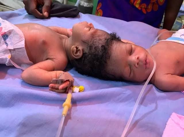 Conjoined twins with fused skulls successfully separated in stunning AI-assisted surgeries - AOL