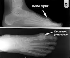 The following list outlines causes of bone spurs on top of the foot Hallux Limitus Arthritis Of The Great Toe Joint Big Toe Arthritis Craig A Wilkes Dpm