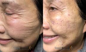 Mesotherapy for fine wrinkles