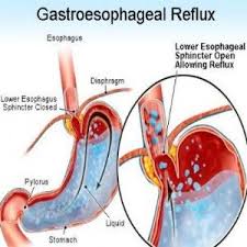 Kenapa cari petua hilangkan gastrik bila sudah ada tanda gastrik? Ubat Gastrik Angin Ubat Gastrik Terbaik
