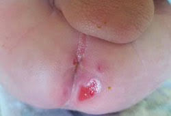 Image result for diaper dermatitis