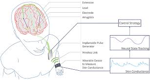 Why are power measurement and control so important? Frontiers Skin Conductance As A Viable Alternative For Closing The Deep Brain Stimulation Loop In Neuropsychiatric Disorders Neuroscience