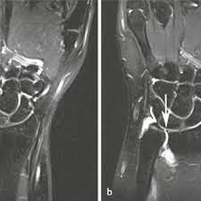 Tfcc injuries in children and adolescents occur more often after an ulnar styloid fracture that doesn't heal. Pdf Detektion Intrinsischer Band Und Tfcc Lasionen Des Handgelenks