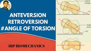 Image result for Femoral Retroversion