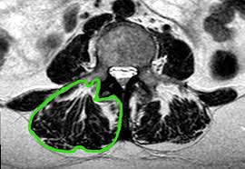 Bone cross sectional geometry and bone strength in male athletes exposed to differential. Paraspinal Muscle Cross Sectional Area Predicts Low Back Disability But Not Pain Intensity The Spine Journal