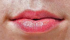 Electrolysis safely and permanently removes blonde, red and gray hair from the face or body. Microscopic Electrolysis For Permanent Hair Removal The Silver Filament