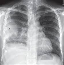 In our study loculated pleural effusion were seen in 8 patients, among which 6 cases were loculated tubercular effusion which were treated with steroids and 2 cases were loculated empyema of which. View Image