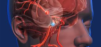 Un mal de tête soudain et sévère est le symptôme clé d'une rupture d'anévrisme. Quels Sont Les Symptomes D Un Anevrisme Cerebral Dr Camargo Mario Villarreal Neurologue