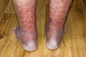 .prevalence of varicose veins and chronic venous insufficiency in men and women in the general 100. Why Early Evaluation Helps You To Avoid Serious Varicose Vein Risks