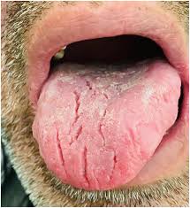Image result for Fissured tongue