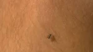 In about 80% of infections people have few or no symptoms. Mother Speaking Out After Son Diagnosed With Severe Case Of West Nile Virus Kutv