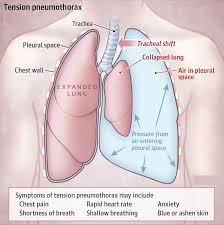 A pneumothorax occurs when air leaks into the space between your lung and chest wall. Hemothorax Causes Signs Symptoms Diagnosis Hemothorax Treatment