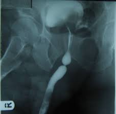 Image result for Retrograde Urethrogram