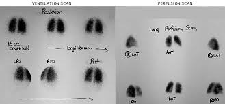Image result for Ventilation Perfusion Scan
