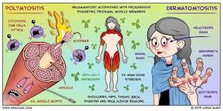 Image result for Polymyositis