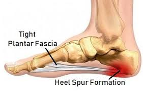Treatment for bone spurs depends on the symptoms one is having. Heel Bone Spurs Causes Symptoms Treatment Foot Pain Explored