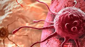 Hodgkin lymphoma (also called hodgkin disease) is a type of cancer that starts in white blood cells called lymphocytes. Lenf Kanseri Lenfoma Nedir Belirtileri Ve Tedavisi Nasildir Ozel Esencan Hastanesi