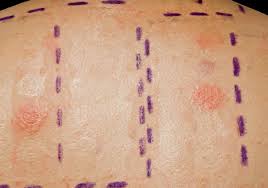 Image result for Patch Testing