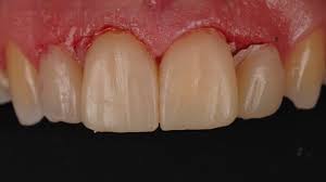 We did not find results for: Ceramic Veneer Cementation Styleitaliano Org