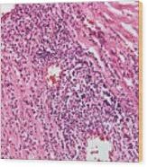 Image result for Cardiovascular Syphilis