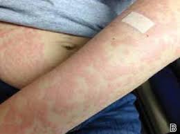 Image result for pruritic urticarial papules and plaques of pregnancy