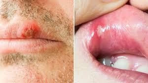 The common cold is infectious from a few days before your symptoms appear until all of the symptoms are gone. Which Is Contagious Your Canker Sore Or Cold Sore Health Essentials From Cleveland Clinic