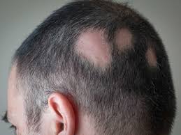 Both gray and white hair are the result of your hair losing its pigment. White Hair Causes And Ways To Prevent It