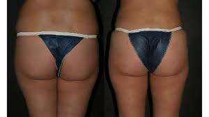 You can also get a free copy of our popular book. Butt Implants Types Risks Costs And Pictures