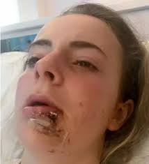 Teenage girl from Wadebridge loses five teeth after horse kicks her in the  face
