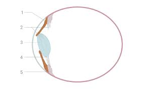 Image result for Lens Dislocation