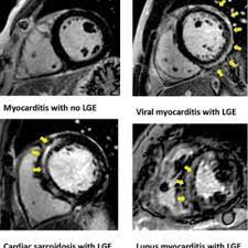 Gadolinium magnetic resonance imaging that can visualize myocardial inflammatory foci may be used as an key words: The Patterns Of Late Gadolinium Enhancement In Various Forms Of Download Scientific Diagram