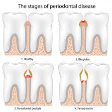 It has deep pocket that contain plaque and calculus which are the etiology of periodontal disease. Dental Deep Cleaning Best Dentist And Orthodontist 60639 60647