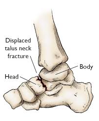 The talus is located above the heel bone, deep in the ankle, and joins with the shin bone above it to form the ankle joint. Talus Fractures Orthoinfo Aaos