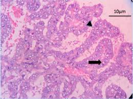 We did not find results for: Thyroid Cancer Concise Medical Knowledge