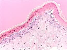Image result for Rhus Dermatitis