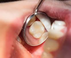 Maybe you would like to learn more about one of these? How Much Does It Cost For Tooth Filling North York Dental Clinic