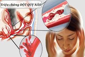 Bệnh đột quỵ nếu không dự phòng và điều trị tốt sẽ có hậu quả rất nguy hiểm đến tính mạng và tàn phế sau này. Giáº£i Ä'ap Tháº¯c Máº¯c Triá»‡u Chá»©ng Ä'á»™t Quá»µ Nao La Gi