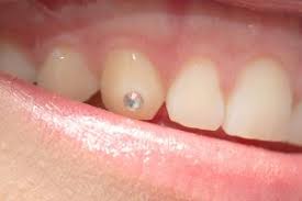 How long will the current fad for tooth jewelry last, only time will tell? The Dangers Of Tooth Gems Stensland Dental Studio