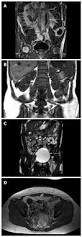 Image result for Incidental Imaging Finding