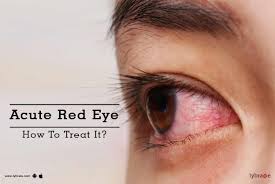 Image result for Acute Red Eye