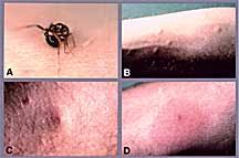 Image result for Fire Ant Sting