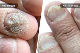 Image result for Pitting nails feet