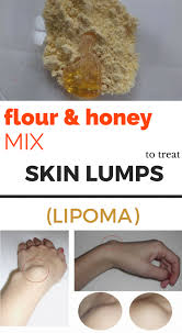 Fatty Lumps Usually Appear On The Head Neck Or Armpit Areas They Are Benign Growths That Can Occu Treat Skin Natural Treatments Lump Behind Ear