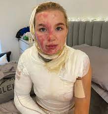 Abbie quinnen has candidly admitted she tried to push her boyfriend aj pritchard away after a horrific accident left her with third degree burns. Aj Pritchard S Girlfriend Abbie Shares Photos Of Her Burns From Horrific Fireball Accident Celebrity News Showbiz Tv Express Co Uk