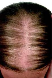 Dianette pills are clinically proven to effectively treat acne and hirsutism in women. Female Pattern Hair Loss Springerlink