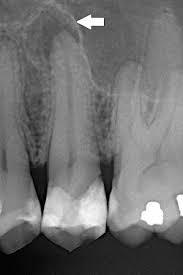 Image result for Periapical Block