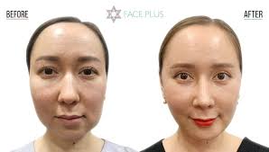 This surgery substantially expands the nose in all dimensions and presents a much elegant look of the face. Bulbous Nose Tip Surgery Face Plus Clinic Korea